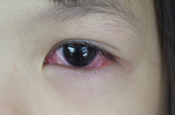 Infeksi Cacing Loa-Loa Di Mata Juga Sangat Berbahaya