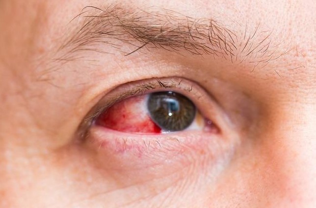 Cara Menghilangkan Darah Beku Di Mata