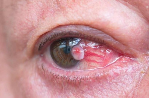 Gejala Kanker Mata Dan Jenis - Jenis Kanker Pada Mata