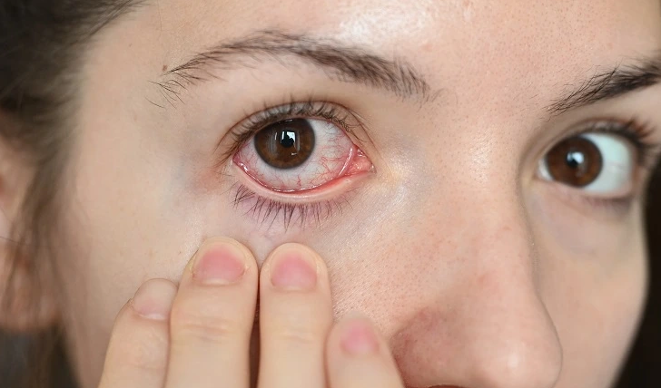 Kondisi Mata Umum dan Penggunaan Salep Mata