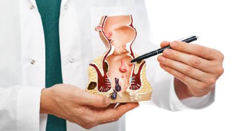 Bagaimana Bentuk Wasir