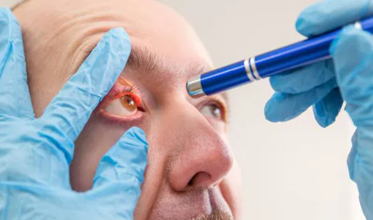 Hordeolum Internal Adalah